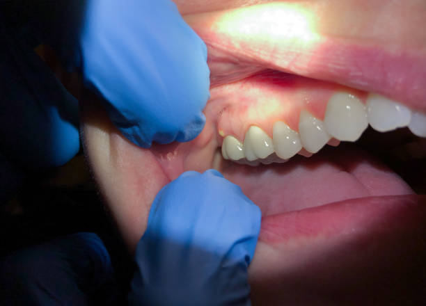 Best Emergency Dental Care for Broken or Chipped Teeth in Laredo, TX